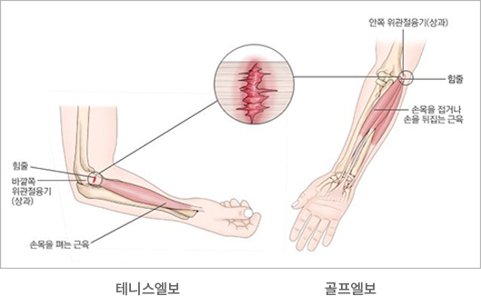 힘줄 바깥쪽 위관절융기(상과) 안쪽 위관절융기(상과) 손목을 접거나 손을 뒤집는 근육 손목을 펴는 근육 테ㅔ니스엘보 골프엘보